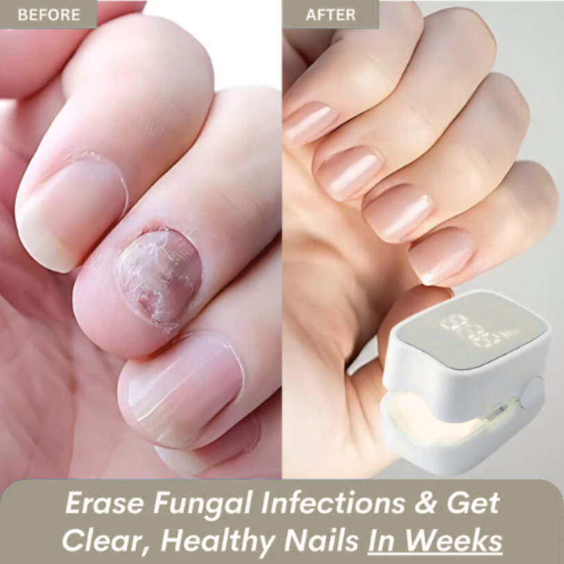 Makelsa™ - Nail Fungus Laser Device