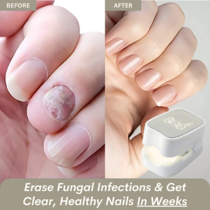 Makelsa™ - Nail Fungus Laser Device