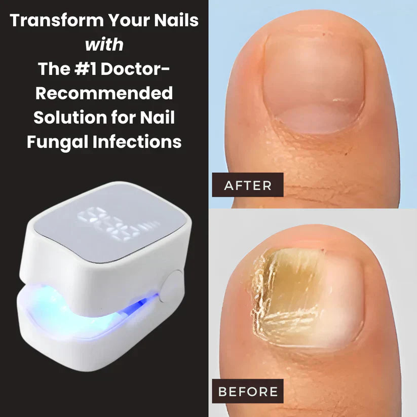 Makelsa™ - Nail Fungus Laser Device