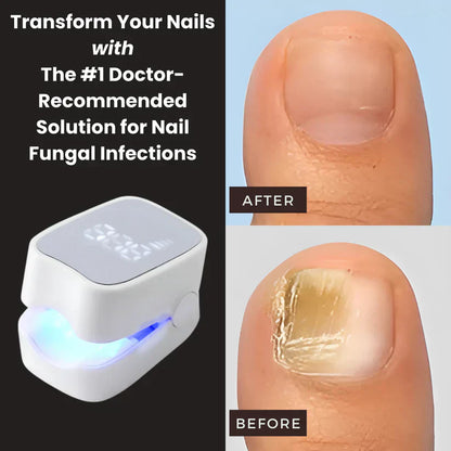 Makelsa™ - Nail Fungus Laser Device